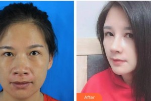 福州海峽美容醫(yī)院李信鋒整形價格表附鼻部手術(shù)案例展示