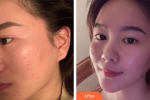 福州美萊華美美容醫(yī)院池卿整形價格表附激光美膚激光案例展示