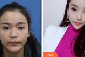 福州臺江醫(yī)院整形美容中心林麗德整形價格表附鼻部整形案例展示