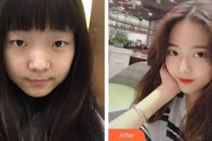 福州美萊華美美容醫(yī)院王燦整形價格表附切開雙眼皮案例展示