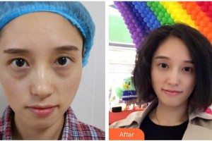 福州市第八人民醫(yī)院整形美容科高征天整形價格表附祛眼袋案例展示