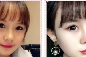 福州中聯(lián)美康整形美容醫(yī)院陳龍整形價格表附面部吸脂項目案例展示