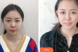 福州海峽美容醫(yī)院藍紹梓整形價格表附激光美膚激光祛黑眼圈案例展示
