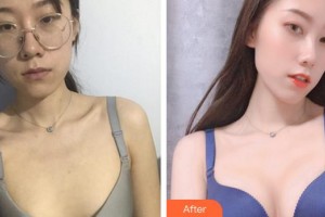 福州市鼓樓醫(yī)院整形美容中心朱金祥整形價格表附自體脂肪豐胸案例展示