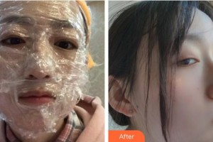 福州美貝爾醫(yī)療美容門診部裴紅整形價格表附激光美膚激光案例展示