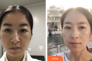 福州海峽美容醫(yī)院池美秀整形價格表附熱瑪吉案例展示