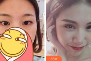 福州優(yōu)美醫(yī)療美容診所吳長飛整形價格表附雙眼皮案例展示