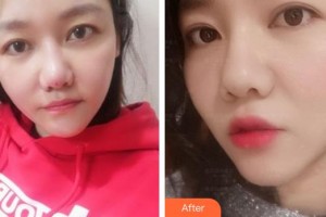 福州臺江醫(yī)院整形美容中心虞守輝整形價格表附埋線提升案例展示