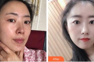 福州愛(ài)美爾整形美容醫(yī)院魏芳整形價(jià)格表附激光美膚激光案例展示