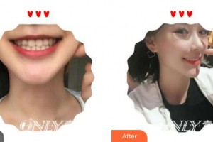 福州海峽美容醫(yī)院鄭純整形價(jià)格表附牙齒美白貼面案例展示