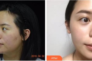 福州美萊華美美容醫(yī)院黃劍媚整形價(jià)格表附緊膚抗衰案例展示