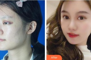 福州中聯(lián)美康整形美容醫(yī)院黃恒平整形價(jià)格表附下頜角肥大案例展示