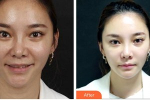 福州臺(tái)江醫(yī)院整形美容中心蕭長(zhǎng)雄整形價(jià)格表附抗衰案例展示