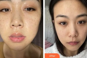 福州曙光整形美容醫(yī)院任海英整形價(jià)格表附超激光美膚祛斑案例展示