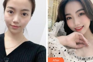 福州愛(ài)思特比華利整形美容醫(yī)院蘇碧鳳整形價(jià)格表附埋線雙眼皮案例展示