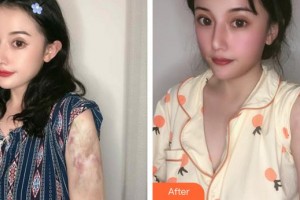 福州市第一醫(yī)院整形美容科朱立群整形價(jià)格表附燙傷疤痕案例展示