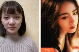 福州中意醫(yī)療美容門診部金成基整形價(jià)格表附肋軟骨隆鼻案例展示