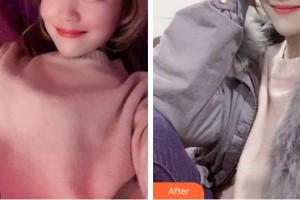 福州美貝爾醫(yī)療美容門診部吳志勇整形價(jià)格表附超聲波潔牙案例展示