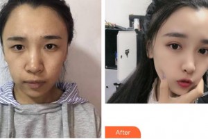 福州莎菲琳(弘宇)整形美容醫(yī)院雷雪華整形價格表附眼部綜合案例展示