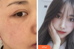 福州市第一醫(yī)院整形美容科鄒丹整形價格表附超激光美膚祛斑案例展示