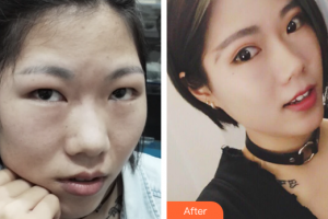 廣州尚美善造美容醫(yī)院邱健整形價格表附切開雙眼皮案例展示
