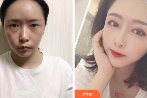 福州美萊華美美容醫(yī)院唐碧云整形價格表附眼部手術案例展示