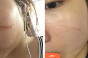 廣州尚美善造美容醫(yī)院陳靖汶整形價格表附點陣祛疤痕案例展示