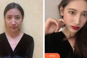 福州市第八人民醫(yī)院整形美容科張鴻超整形價格表附肋軟骨隆鼻案例展示