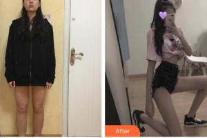 福州美萊華美美容醫(yī)院申峻昊整形價格表附大腿吸脂案例展示