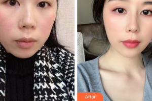 廣州華醫(yī)醫(yī)療美容門診部鐘學成整形價格表附耳軟骨復合隆鼻案例展示