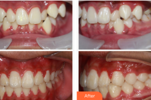 廣州華醫(yī)醫(yī)療美容門診部陳宏錦整形價格表附隱適美牙齒矯正案例展示