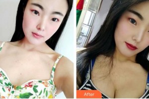 福州秀清醫(yī)療美容診所胡軍整形價格表附隆胸案例展示