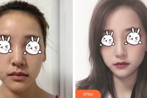 福州美萊華美美容醫(yī)院陳力楊整形價格表附下巴注射結合嗨體、線材改良嘟案例展示