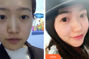 廣州基立嘉韓醫(yī)學整形美容醫(yī)院黃軍彬整形價格表附眼部整形案例展示