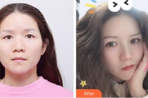 福州悅己醫(yī)療美容診所陳楓整形價格表附埋線雙眼皮+去脂肪案例展示