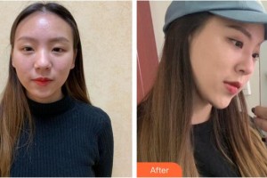 福州臺(tái)江醫(yī)院整形美容中心李文信整形價(jià)格表附隆鼻案例展示