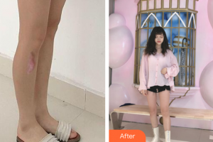 廣州基立嘉韓醫(yī)學整形美容醫(yī)院林彩環(huán)整形價格表附增生疤痕案例展示