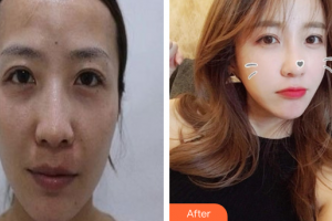 廣州基立嘉韓醫(yī)學整形美容醫(yī)院杜欣逸整形價格表附自體脂肪全臉填充案例展示