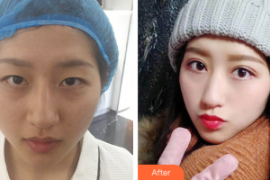 廣州基立嘉韓醫(yī)學整形美容醫(yī)院劉朝忠整形價格表附眼部綜合案例展示