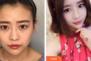 廣州基立嘉韓醫(yī)學(xué)整形美容醫(yī)院吳紅整形價格表附熱瑪吉多方面部案例展示