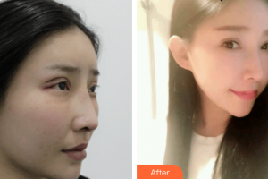 廣州基立嘉韓醫(yī)學(xué)整形美容醫(yī)院楊國華整形價格表附雙眼皮修復(fù)案例展示