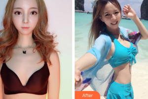 廣州美瑞兒醫(yī)療美容門診部樸一鴻整形價格表附自體脂肪隆胸案例展示