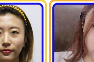 福州名韓整形美容醫(yī)院卓敬錫整形價格表附眼部綜合案例展示