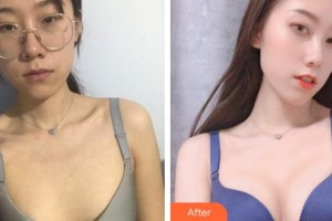 福州格萊美醫(yī)療美容醫(yī)院劉海整形價格表附隆胸案例展示