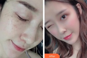 福州海峽美容醫(yī)院林秀蘭整形價格表附眼部手術(shù)案例展示