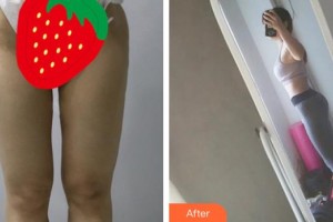 福州曙光整形美容醫(yī)院崔立龍整形價格表附吸脂案例展示