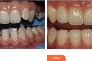 福州海峽美容醫(yī)院曾姍姍整形價格表附牙齒隱形矯正案例展示