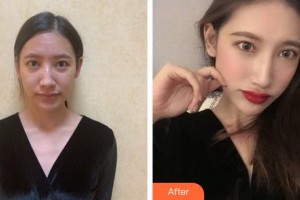 福州海峽美容醫(yī)院呂劍昇整形價格表附鼻部手術案例展示