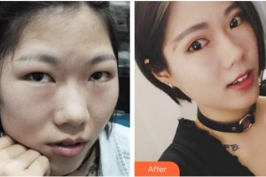 福州格萊美醫(yī)療美容醫(yī)院鄭海鎮(zhèn)整形價格表附切開雙眼皮案例展示