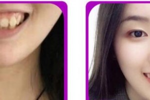 福州格萊美醫(yī)療美容醫(yī)院吳和峰整形價格表附隱形正畸案例展示